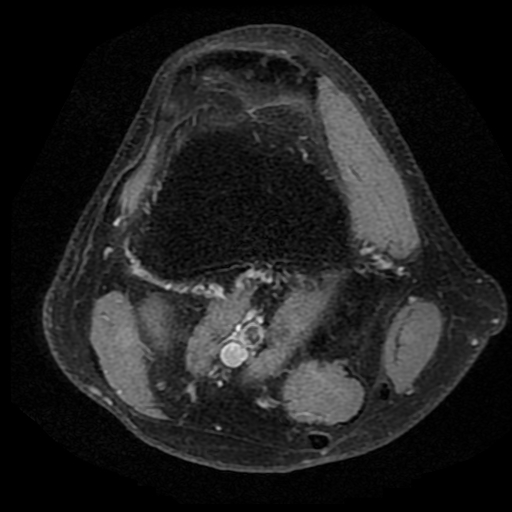 Figure 3 for case Third head of the gastrocnemius